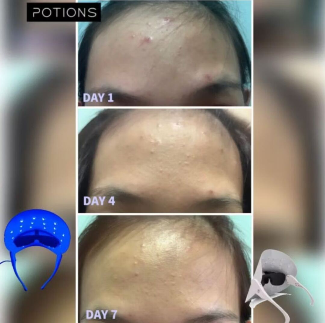 [SG INSTOCK] Allureskin Potions LED Photon Therapy Mask. 