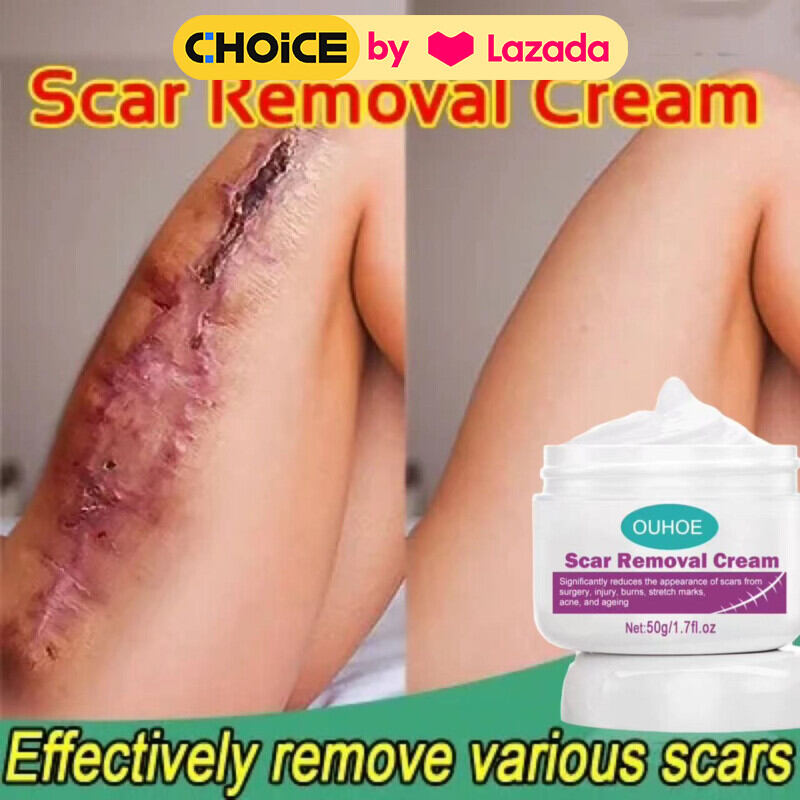 Kem Xóa Sẹo, Làm Lành Vết Thương Cũ Muỗi Cắn, Sẹo Lồi OUHOE