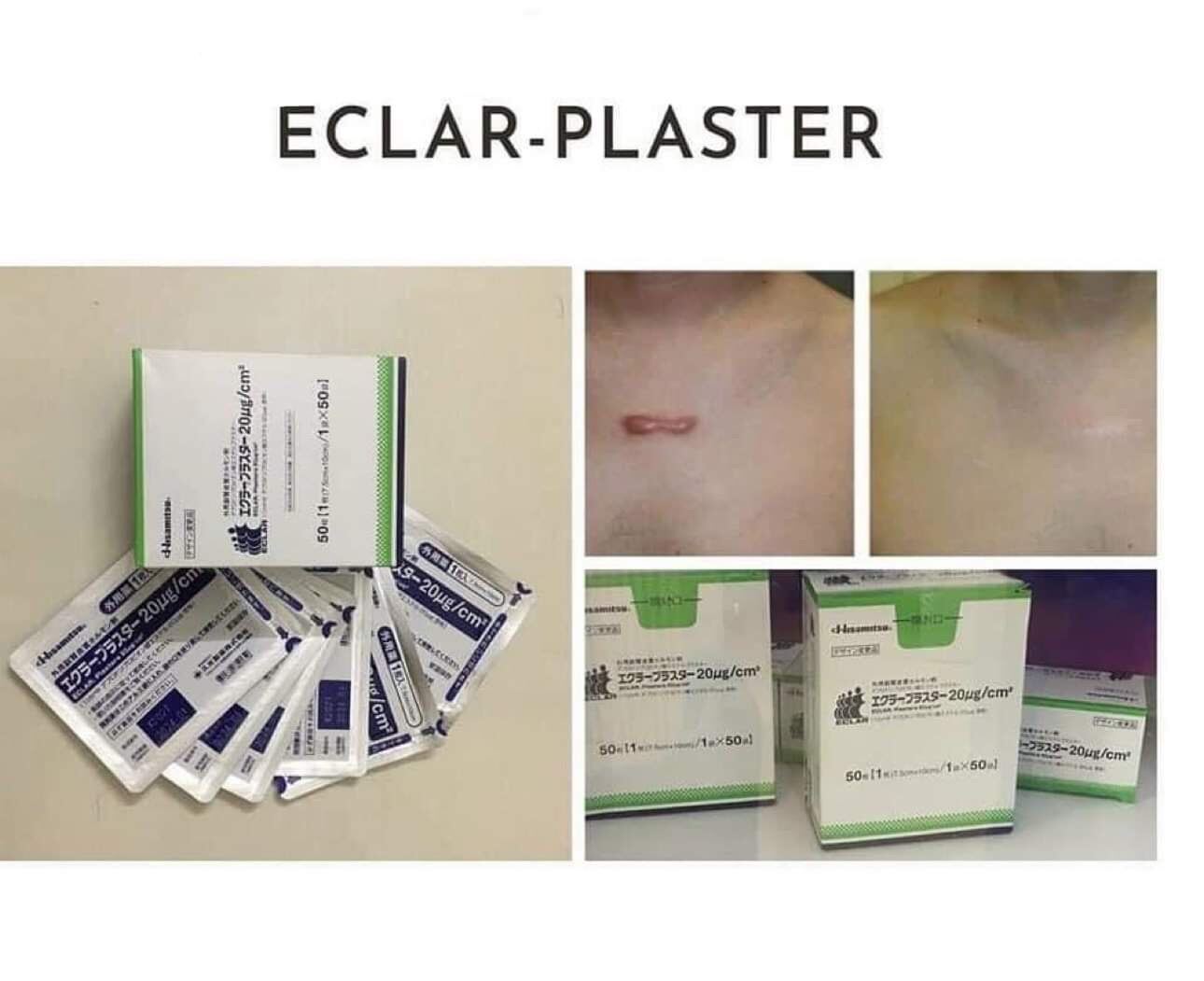 Sg Stock 🌟 Scar Removal Keloid Treatment Hisamitsu Eclar Plaster